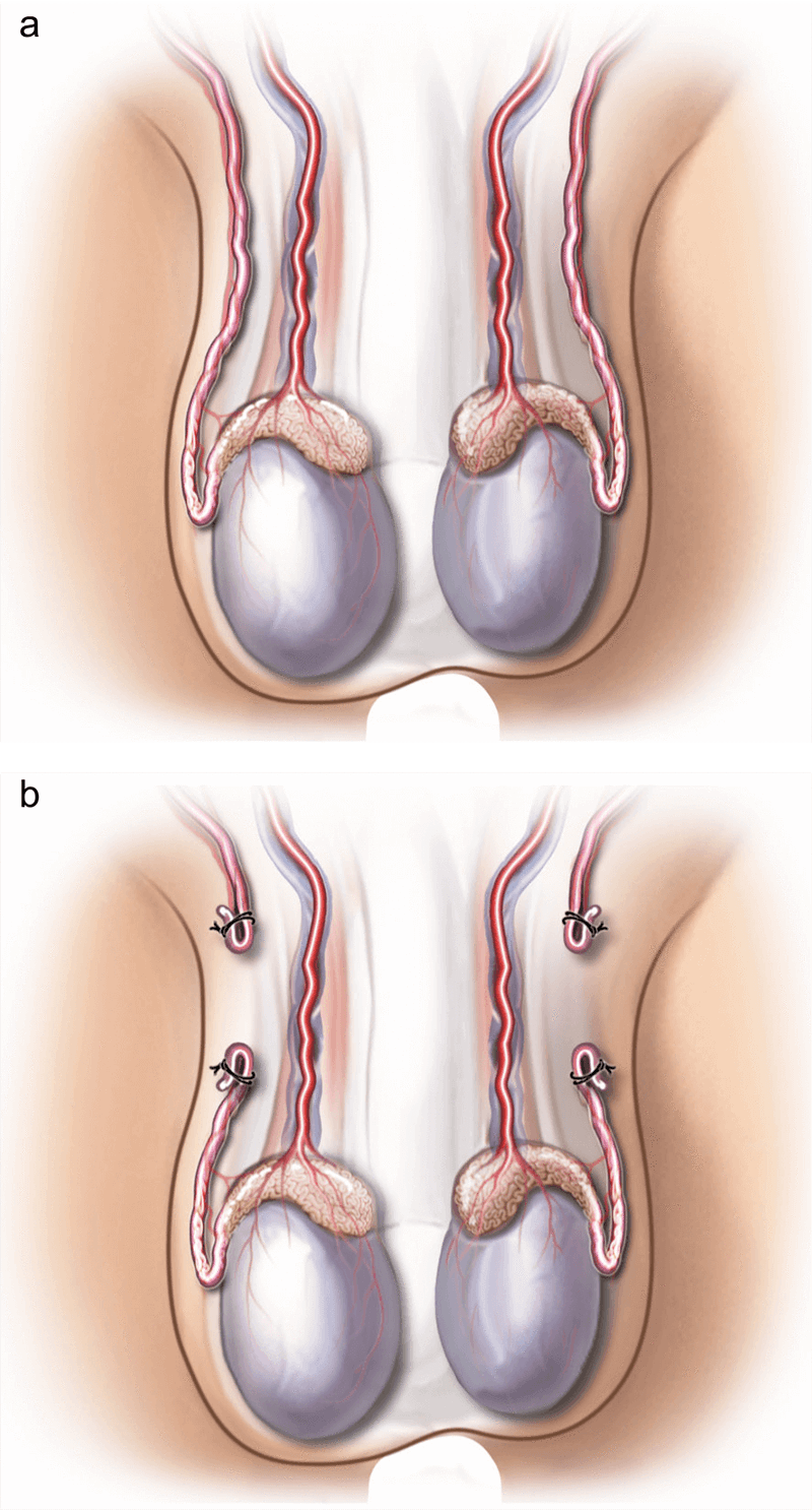 vasectomy